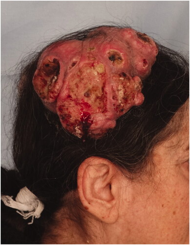 Figure 8. Tumor located in the right parietal region, with multiple ulcerated areas on it.