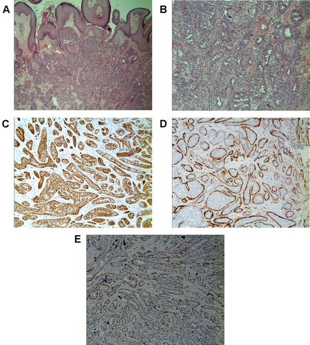 Figure 2 (A and B) Histopathology reveals ductal differentiation. (Hematoxylin-eosin stain, Original magnification×40 (A); Original magnification×200 (B)). The luminal epithelial cells were positive for (C) CK5/6 stain. (Immunohistochemistry, original magnification×100). The out-layer myoepithelial cells were positive for (D) SMA and (E) p63 stains. (Immunohistochemistry, original magnification×100).