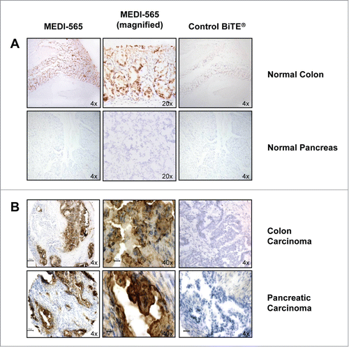 Figure 1. Binding of MEDI-565 to normal and malignant human tissue sections. (A) Representative immunohistochemistry (IHC) images of normal human colon epithelium and normal human pancreas tissues stained with MEDI-565 or control BiTE® antibody construct. (B) Representative IHC images of human colorectal and pancreatic carcinoma tissues stained with MEDI-565 or control BiTE® antibody construct.