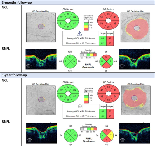 Figure 1 Evaluation of ganglion cell layer (GCL) and retinal nerve fiber layer (RNFL) in Optical Coherence Tomography (OCT) of a patient with myelin oligodendrocyte glycoprotein (MOG) antibody-associated optic neuritis during 1-year follow-up.