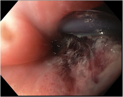 Figure 2. The perforation photographed from an esophagoscope before stenting. The Blake drainage is visible.
