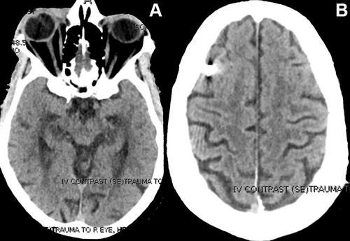 Figure 2 A CT scan of the orbit, paranasal sinuses, and complete brain images obtained on a repeat scan. (A) Axial scan shows the intact globe with no foreign body. (B) Axial scan of the brain showing a metallic foreign body in the temporal region of the right frontal lobe.