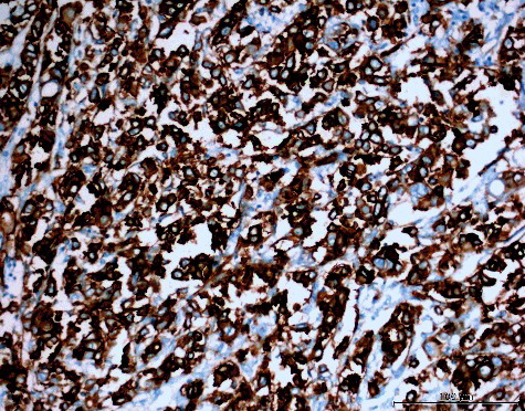 Figure 1. Diffuse (extensity score = 4) and strong (intensity score = 3) expression of AQP1 in MPM (AQP1 200×).