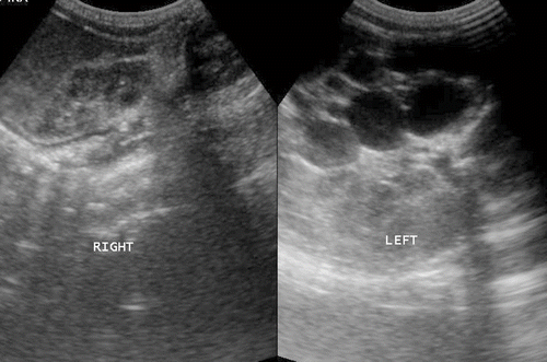 Figure 1. Ultrasound of the kidneys: hypoplastic right kidney and multicystic left kidney.