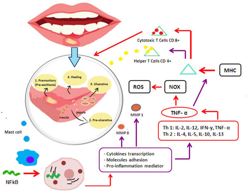 Figure 2 Inflammation process induced Recurrent Aphthous Stomatitis (RAS).