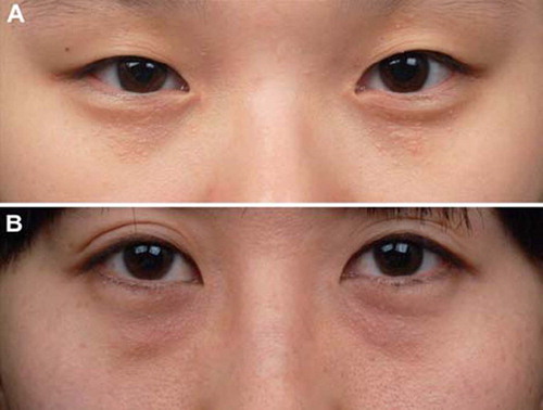 Figure 1. (A) Multiple skin-colored discrete and confluent papules on the upper and lower eyelids diagnosed as syringomas. (B) Multiple skin-colored follicular papules on the lower eyelids diagnosed as sebaceous gland prominence of the eyelids.