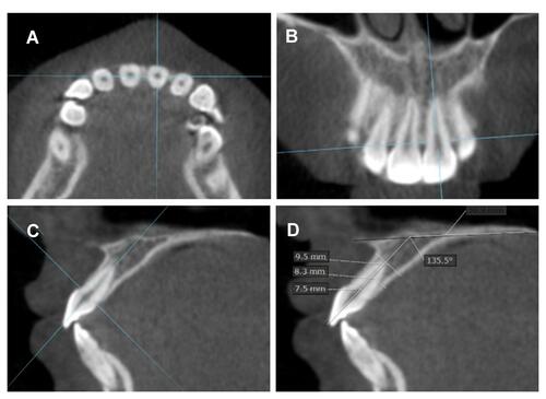 Figure 1 CBCT Images generated parallel to the tooth axis in the: (A) axial, (B) coronal, and (C) sagittal planes. (D) Sagittal reconstruct showing measurements of the AMABT at alveolar crest, mid-root, and apex, as well as the Inc/PP angle.