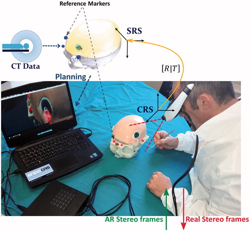 Figure 2. Video see-through paradigm of the augmented reality neuronavigator. The software application merges the virtual three-dimensional surgical planning with the stereoscopic views of the surgical scene grabbed by the stereo rig. Thereafter, the augmented reality stereo frames are sent to the two internal monitors of the visor. Alignment between real and virtual information is obtained by a tracking modality that relies on the localization of at least three reference markers rigidly constrained to the head phantom and whose position in the virtual scene (SRS) is recorded during surgical planning.