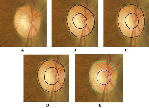 Figure 2 Representative digital, non-stereo optic disc image shown on computer tablet. The left image (A) is the non-stereo optic disc image from a macula-centered DRS photography. The three middle images (B–D) are the same optic disc image that show the manual annotations by the three ophthalmologists as grading 3 method described in “Materials and Methods, optic nerve assessment”. The right image (E) is the automated segmentation of the optic disc and optic cup margins, grading 4. Overall the optic disc and optic cup margins showed small variations among the three ophthalmologists’ manual markings (grading 3) and the computer automated margins (grading 4).
