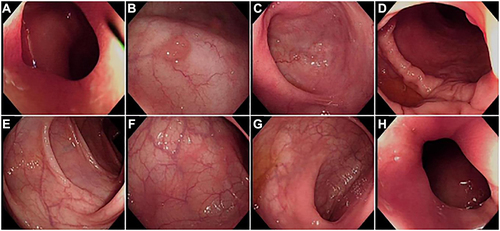 Figure 4 (A) Ileocecal orifice; (B) cecum; (C) ascending colon; (D) ascending colon; (E) transverse colon; (F) sigmoid colon; (G) rectum; (H) anal canal.
