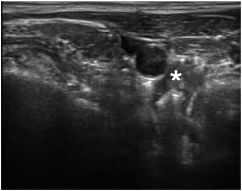 Figure 4. Noticeable reduction in the size of the parathyroid adenoma after bRFA (in comparison to Figure 1). (* = Adenoma).