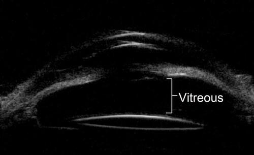 Figure 2 Ultrasound biomicroscopy (UBM) showed shallow anterior chamber with abnormal position of scleral-fixated intraocular lens.