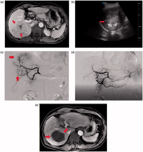 Figure 1. Microwave ablation combined with chemoembolization was performed in a 70-year-old male patient with large HCC. (a) Contrast-enhanced MRI shows a large lesion (8.4 cm* 7.8 cm *6.4 cm) in the right lobe of the liver (arrows). (b) MWA using water-cooled microwave system was performed with cooled-shaft electrode probe (arrows) under real-time ultrasound guidance. (c) After the chemoembolization procedure, selective angiography demonstrated complete devascularization of the targeted lesion (arrows). (d) Contrast-enhanced MRI scan obtained 3 months after combined treatment (arrows).