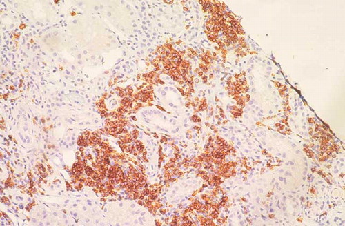 Figure 2.  Immunohistochemistry for CD20 showing that infiltrating lymphocytes were CD20 + (200×).