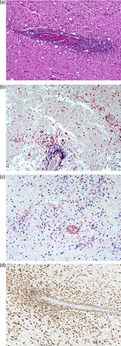 Figure 4. Histopathologic findings of BoDV-1 encephalitis (case 2). A, Severe inflammation as reflected by mononuclear cell infiltration and perivascular cuffing. Hematoxylin and eosin stain of the thalamus, original magnification ×50. B, Perivascular accumulation of B cells (CD20, blue) and T cells (CD3, red). While B cells demonstrated mainly perivascular cuffing, T cells were additionally infiltrating the brain parenchyma in high numbers. Immunoperoxidase and immunophosphatase stains of the hippocampus, original magnification ×100. C, Distribution of CD4+ (red) and CD8+ (blue) T lymphocytes in inflammatory infiltrates. Immunoperoxidase and immunophosphatase stains of the hippocampus, original magnification ×100. D, Microglia activation in inflamed regions of the brain. Immunoperoxidase stain for CD68 with hematoxylin counterstain of the thalamus, original magnification ×50.