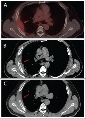 Figure 3. Tumor remarkable shrinkage was confirmed. PET-CT before the commencement of celecoxib on April 2014 A. CT scan on November 2015 B. and on October 2016 C. showed that tumor was smaller after using celecoxib.