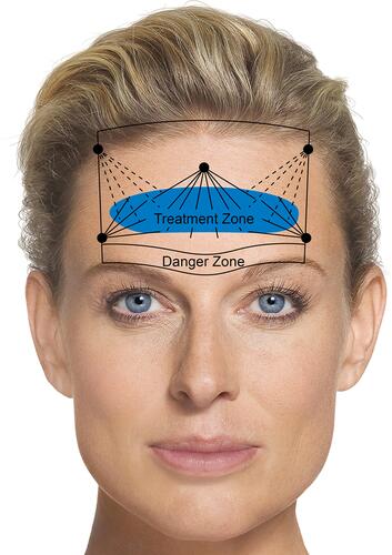 Figure 1 Forehead entry points and treatment zone. Black lines: limits of the forehead area (temporal crest, hairline, supraorbital rim) and limits of the arterial danger zone (1.5–2.0 cm superior to the supraorbital rim). Black dots: entry points. Lines from black dots: retrograde linear threads of 0.025–0.04 mL CPM-HA I or CPM-HA V with a 22G cannula, bevel directed towards the periosteum. Dotted black lines: optional additional retrograde linear threads. Image courtesy from Merz Pharmaceutical GmbH.