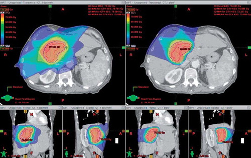 Figure 1. Patient with solitary liver metastasis (CTV = 84 cm3) planned with IMRT (left) and IMPT (right). Threshold for dose colour wash is 15 Gy. Red and purple lines indicate CTV and PTV, respectively.