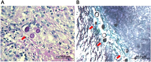 Figure 2. Histopathological examination of biopsy tissue. PAS staining (A) and GMS staining (B) showing multiple thick-walled spherules and endospores (arrowhead) in the nodules.