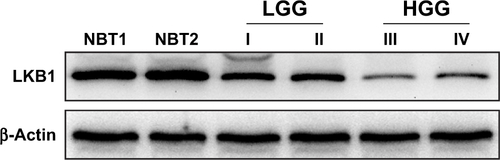Figure S1 LKB1 expression levels in two NBTs and glioma tissues of various grades.Abbreviations: LKB1, liver kinase B1; NBT, normal brain tissue.