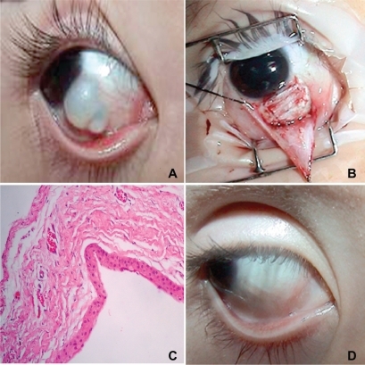 Figure 1 A) Multiloculated intrascleral cystic mass at presentation. B) Banked fascia lata covering the scleral defect after excision of the cyst. C) Photomicrograph of the cyst wall layered with nonkeratinized squamous epithelium (HE X100). D) The appereance of the eye 6 months after surgery.