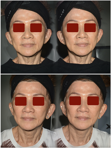 Figure 9 Representative aesthetic benefits foreseeable for PN HPT examples in a middle-aged woman; photographs taken from two slightly different perspectives. Pictures published with the subject’s written agreement. Image courtesy of Dr Xiang Jie Tee.