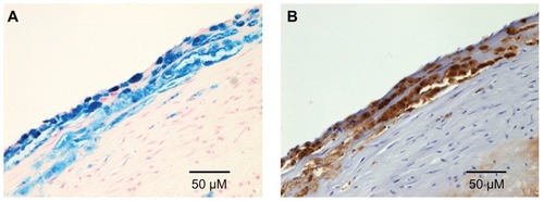 Figure 5 (A) Prussian blue and (B) immunohistochemical (RAM11) staining of histopathological sections from WHHL rabbits injected with DM-USPIO at dose 3 (0.8 mmol Fe/Kg).Note: The localization of iron and macrophages was correlated.Abbreviations: DM-USPIO, mannan–dextran-coated ultrasmall superparamagnetic iron oxide; WHHL, Watanabe heritable hyperlipidemic.
