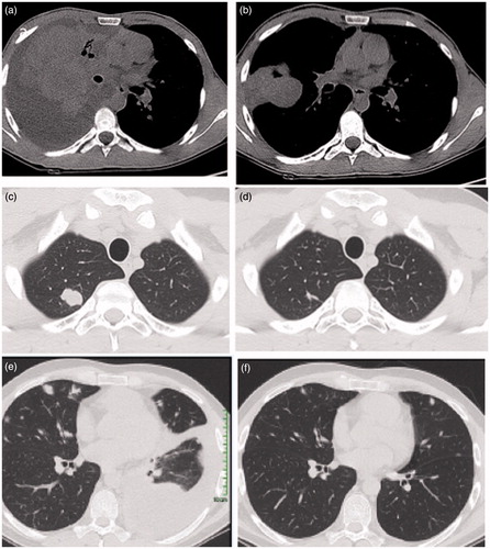 Figure 1. Massive pleural effusion and lung metastases before (a) and (b) after two cycles of chemotherapy with temozolomide and irinotecan; lung apical nodule before (c) and after (d) treatment; bilateral lung metastases and lower lung lobe pleura effusion before (e) and (f) after chemotherapy.