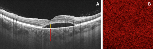 Figure 1 (A) OCT B-scan used to analyze subretinal fluid and choroidal thickness in exudative cCSC pachychoroid eye. Subretinal fluid height was assessed by manually measuring the distance between the external limiting membrane and the RPE at the fovea (yellow arrow). Sub-foveal choroidal thickness was measured with the caliper function of structural OCT. The SFCT was measured from Bruch’s membrane to the chorio-retinal interface perpendicularly in the center of the fovea (red arrow); (B) Swept-source OCTA image of the choriocapillaris in non-exudative fellow cCSC pachychoroid eye used to analyze choriocapillaris flow deficits percentage. The CC images were binarized using the Phansalkar method using a radius of 15 pixels to calculate the choriocapillaris FD percentage.