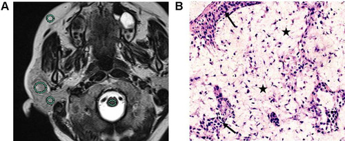 Figure 2 Pleomorphic adenoma of the right parotid gland in a 48-year-old woman. (A) T2-weighted image showed that SIRP, SIRC and SIRF were 1.38 (847.18/613.80), 2.32 (848.18/365.16), and 0.89 (848.18/951.89), respectively. (B) Pathological image (original magnification × 200) revealed large amounts of mucus areas (black pentagram) and cell-rich areas (black arrow).