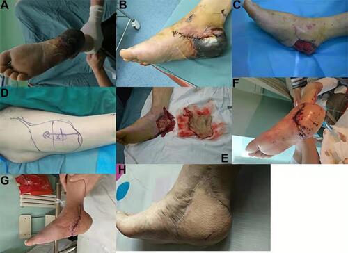Figure 3 Avulsion injury and necrosis of skin and soft tissue of right calcaneus, repair of anterior lateral perforator flap of ipsilateral femur. (A and B) Preoperative appearance photo. (C) Wound surface after VSD coverage. (D) Ipsilateral femoral anterolateral flap design, size 12.5 cm × 18cm. (E) Split flap. (F) Postoperative appearance (1 week). (G) Postoperative appearance (3 weeks). (H) 42 months follow-up after operation, 2PD11mm, satisfactory function and appearance.