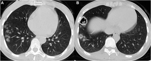 Figure 1 A 24-year-old woman with HIV infection and pulmonary cryptococcosis. She has headache and fever for ten days, and cryptococcal meningitis is confirmed. (A and B) Axial CT images show multiple clustered nodules with different sizes located in the subpleural zone of right lower lobe. (B) Cavities are detected in the bigger nodules.