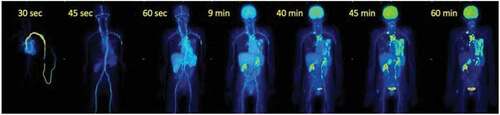 Figure 1. An example of 18F-FDG Maximum Intensity Projection (MIP) images obtained by dynamic acquisition with a LAFOV PET/CT scanner (Biograph Vision Quadra, Siemens Healthineers) in a patient with metastatic melanoma and several lesions in the thoracic area (image courtesy of Prof. Antonia Dimitrakopoulou-Strauss).