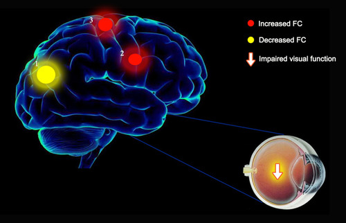 Figure 6 FC results of the right V1 in the CU group. FC of the right V1 of patients with CU in the 1-right cuneus (t=−3.8940) was decreased compared with that reported in HCs. In contrast, FC values in the 2-right cingulate gyrus (t=3.5412) and 3-left superior frontal gyrus (t=4.2424) were increased to various extents.