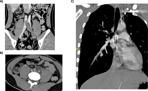 Figure 2 CT angiography findings at diagnosis. (A) Thrombosis in the left iliac vein that appears in the IVC; (B) Thrombosis in the left iliac vein without clear compression syndrome at the crossing behind the right iliac artery; (C) PE in branches of the right basal pyramid artery.