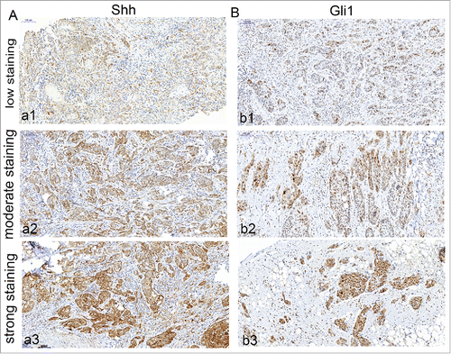 Figure 1. Immunohistochemical detection of Shh, Gli1 in OSCC specimens. A, cytoplasm expression of OSCC specimen for Shh (a1, low staining; a2, moderate staining; a3, strong staining); B, nuclear and cytoplasm expression of OSCC specimen for Gli1 (b1, low staining; b2, moderate staining; b3, strong staining). Bars indicate 100 um.