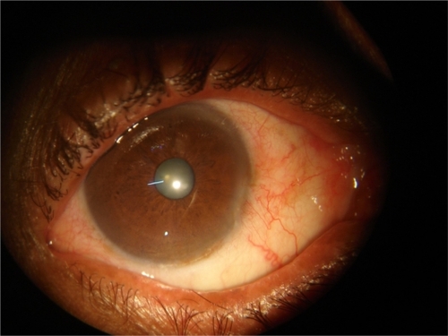 Figure 2B Right eye appearance after 6 months of 5-FU.