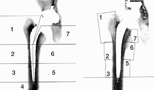 Figure 14. Classification of periprosthetic BMD on femoral side in 7 ROIs according to Gruen for automatic (left) and manual (right) DEXA analysis.