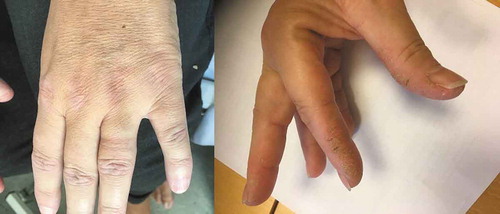Figure 3. Left: Gottron’s papules; right: mechanic’s hands.