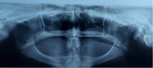 Figure 5 Panoramic Radiography confirming complete anodontia.