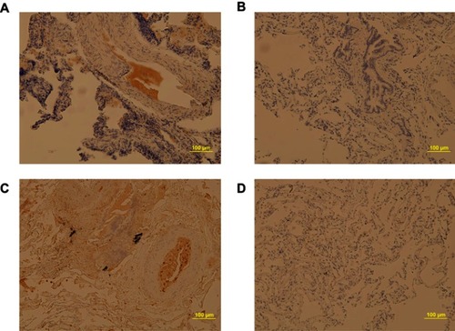 Figure 6 Immunostaining of C-reactive protein (CRP) and serum amyloid A (SAA) in lung biopsies of patients. Pulmonary parenchyma stained with CRP of a COPD (panel A) and control (panel B). Pulmonary parenchyma stained with SAA of COPD patient (panel C) and control patients (panel D). Scale bar represents 100 μm in each case.