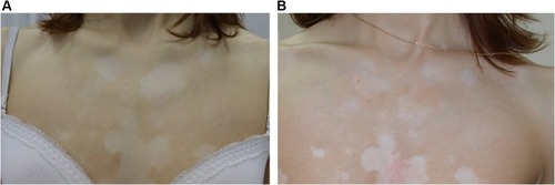 Figure 3 Patient B, areas of vitiligo on the upper chest (A) before and (B) 2 weeks after treatment with NCTF135.