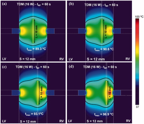 Figure 10. Effect of the displacement of the RF-energised guidewire (10 mm length) to one side on the temperature distributions and thermal lesion contours (black line). The lateral displacement considered from the midpoint of the septum was: (a) 0 mm (without displacement), (b) 1 mm, (c) 2 mm and (c) 3 mm. Computer simulations were stopped when maximal temperature in the tissue reached 100 °C (tRF).