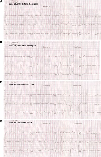 Figure 4 ECG during stent thrombosis.