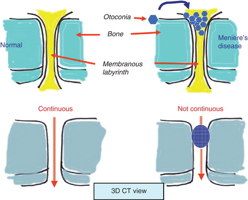 Figure 2. Drawings demonstrating the patency of the reuniting duct (RD), saccular duct (SD) and endolymphatic sinus (ES) on 3D CT images. When otoconia are dislodged into the RD, SD or ES, they lose continuity of the surface of their bony grooves and become vague on 3D CT images.