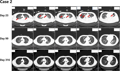 Figure 5 Lung CT scans obtained of case 2.