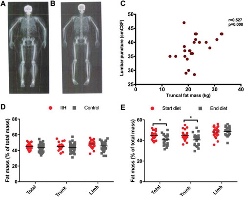 Figure 1. Fat distribution in IIH and response to weight loss. Example DEXA imaging before (A) and after (B) weight loss. (C) Correlation between truncal fat mass and lumbar puncture (LP) pressure. (D) Fat mass distribution in IIH compared with controls. (E) Percentages of fat mass in IIH before and after weight loss (*p < 0.05).