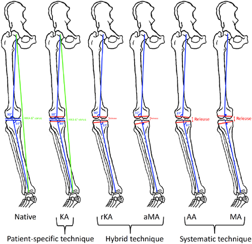 Figure 1 Different techniques for alignment in total knee arthroplasty.