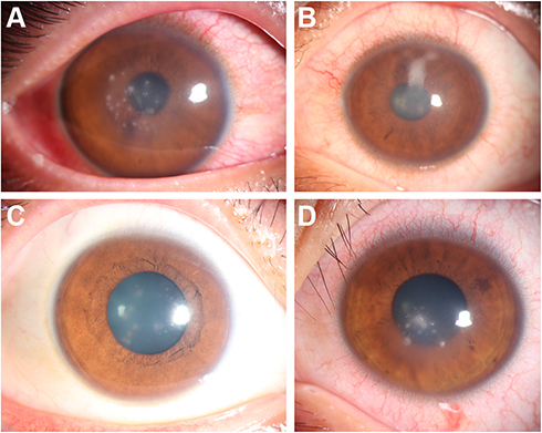 Figure 1 Initial slit lamp examination of the involved eyes. (A) patient 1 presented with multiple punctate infiltrations in the stromal of the pericentral corneal and moderate conjunctival injection 3 days after surgery; (B) patient 2 presented with corneal stromal edema and opacity 1 week after surgery; (C) patient 3 presented with corneal opacity and stromal edema 1 month after surgery; (D) patient 4 presented with multiple punctate infiltrations in the stromal of the pericentral corneal 3 days after surgery.