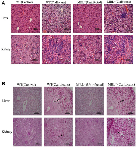 Figure 5 Histopathological changes in WT and MBL−/− mouse tissues after invasive Candida albicans infection. (A) Representative images of Hematoxylin and eosin (H&E)-stained liver and kidney. (B) Representative images of PAS-stained liver and kidney. (×400 magnification, Scale bar = 100μm). The arrows indicate representative C. albicans hyphae.